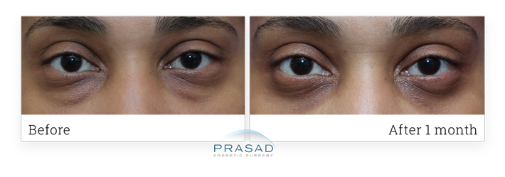 Real patient before and after eye bags removal surgery