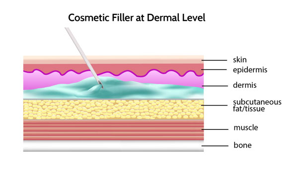 cosmetic filler at the dermal level can migrate and look heavy