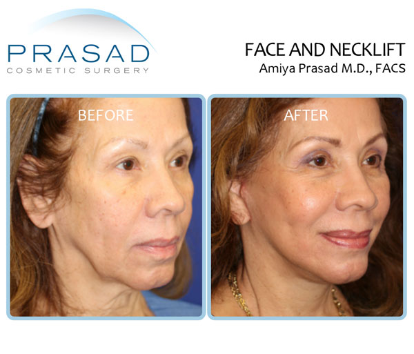 Deep plane face and neck lift before and after