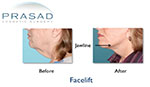 Facelift patient before and after 1 photo
