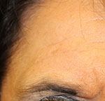 after PRP treatment on forehead