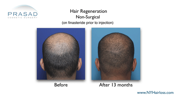 Hair Regeneration combined with finasteride works best for young men with high DHT-sensitivity 