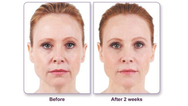 Before and after Juvederm application