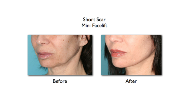 Short scar mini facelift before and after 