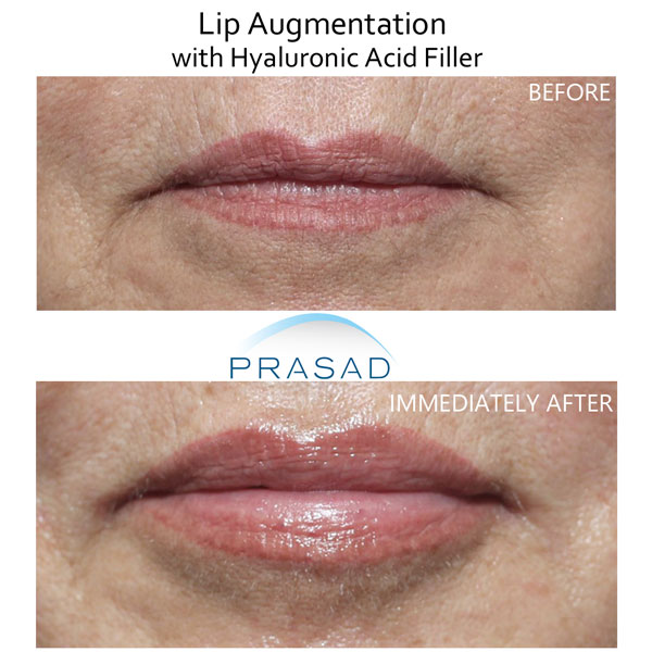 Lip augmentation with hyaluronic acid filler