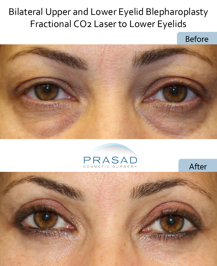 PRP and Laser combined to treat dark under eye circles