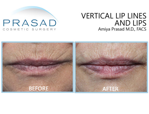 Vertical lip lines before and after fillers.